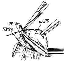 闭式二尖瓣交界分离术图片