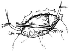 闭式二尖瓣交界分离术图片