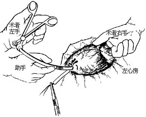 闭式二尖瓣交界分离术图片