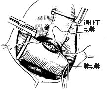 法乐四联症纠治术图片