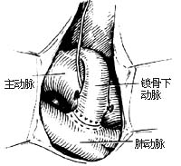 法乐四联症纠治术图片