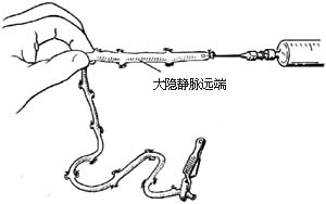 冠状动脉旁路移植术图片