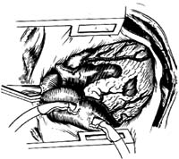 冠状动脉旁路移植术图片