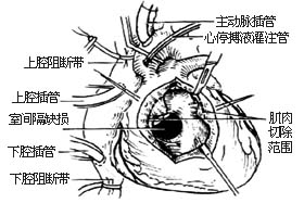 法乐四联症纠治术图片