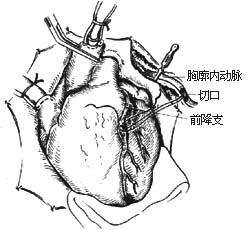 冠状动脉旁路移植术图片