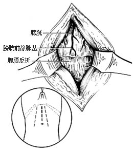 耻骨上膀胱造瘘术图片