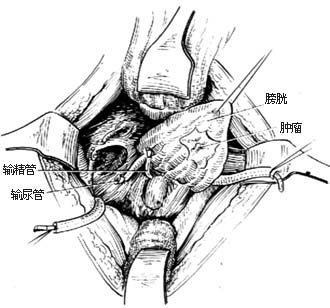 全膀胱切除术图片