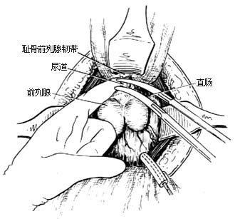 全膀胱切除术图片