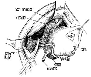 全膀胱切除术图片
