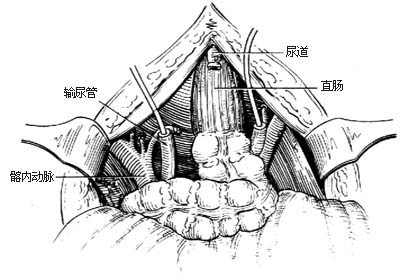 全膀胱切除术图片