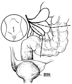 肠膀胱扩大术图片
