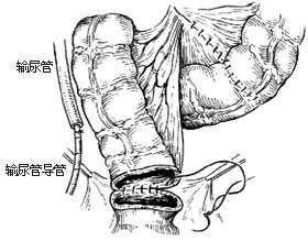肠膀胱扩大术图片