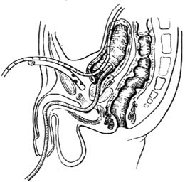 肠膀胱扩大术图片