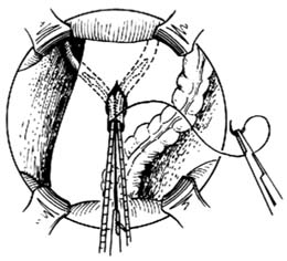 回肠膀胱术图片