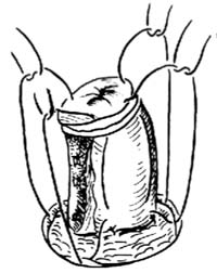 回肠膀胱术图片