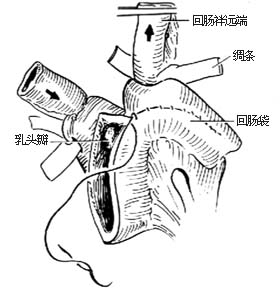 可控性回肠膀胱术图片