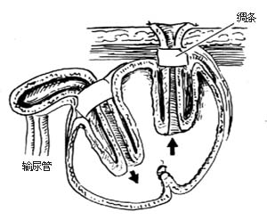 可控性回肠膀胱术图片