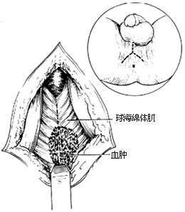 球部尿道损伤修复术图片