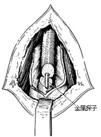 球部尿道损伤修复术图片