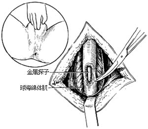 尿道狭窄修复术图片