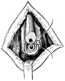 尿道狭窄修复术图片