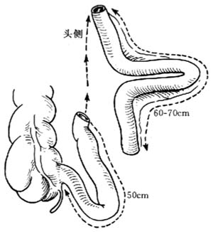 可控性回肠膀胱术图片