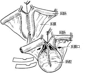 可控性回肠膀胱术图片