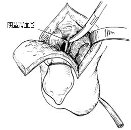 阴茎全切除术图片
