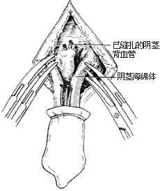 阴茎全切除术图片