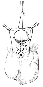 分期尿道下裂修复术图片