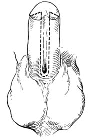 分期尿道下裂修复术图片