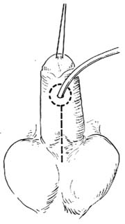 一期尿道下裂修复术图片
