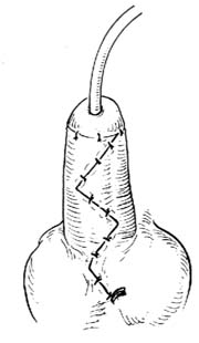 一期尿道下裂修复术图片