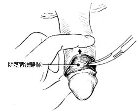 包皮环切术图片