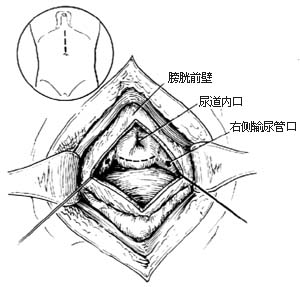 耻骨上经膀胱前列腺切除术图片