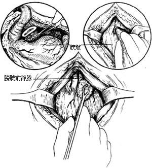 耻骨后膀胱外前列腺切除术图片