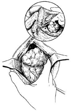 耻骨后膀胱外前列腺切除术图片