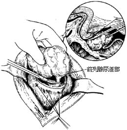 耻骨后膀胱外前列腺切除术图片