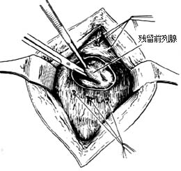 耻骨后膀胱外前列腺切除术图片
