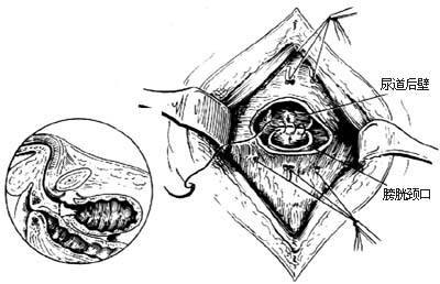 耻骨后膀胱外前列腺切除术图片