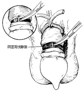 阴茎部分切除术图片