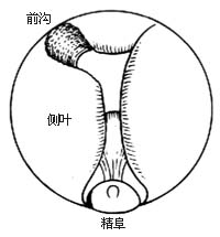 经尿道前列腺电切术图片