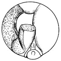 经尿道前列腺电切术图片