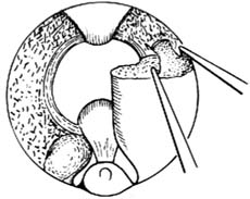 经尿道前列腺电切术图片