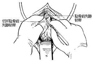 耻骨后根治性前列腺切除术图片