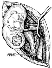 肾部分切除术图片