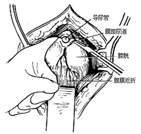 耻骨后根治性前列腺切除术图片