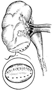 肾部分切除术图片