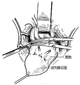 耻骨后根治性前列腺切除术图片