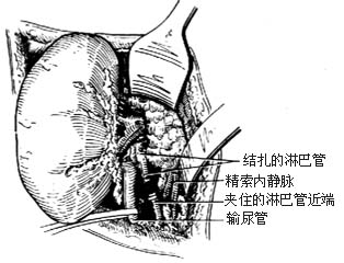 肾蒂淋巴管结扎、肾蒂淋巴管精索内（卵巢）静脉吻合术图片